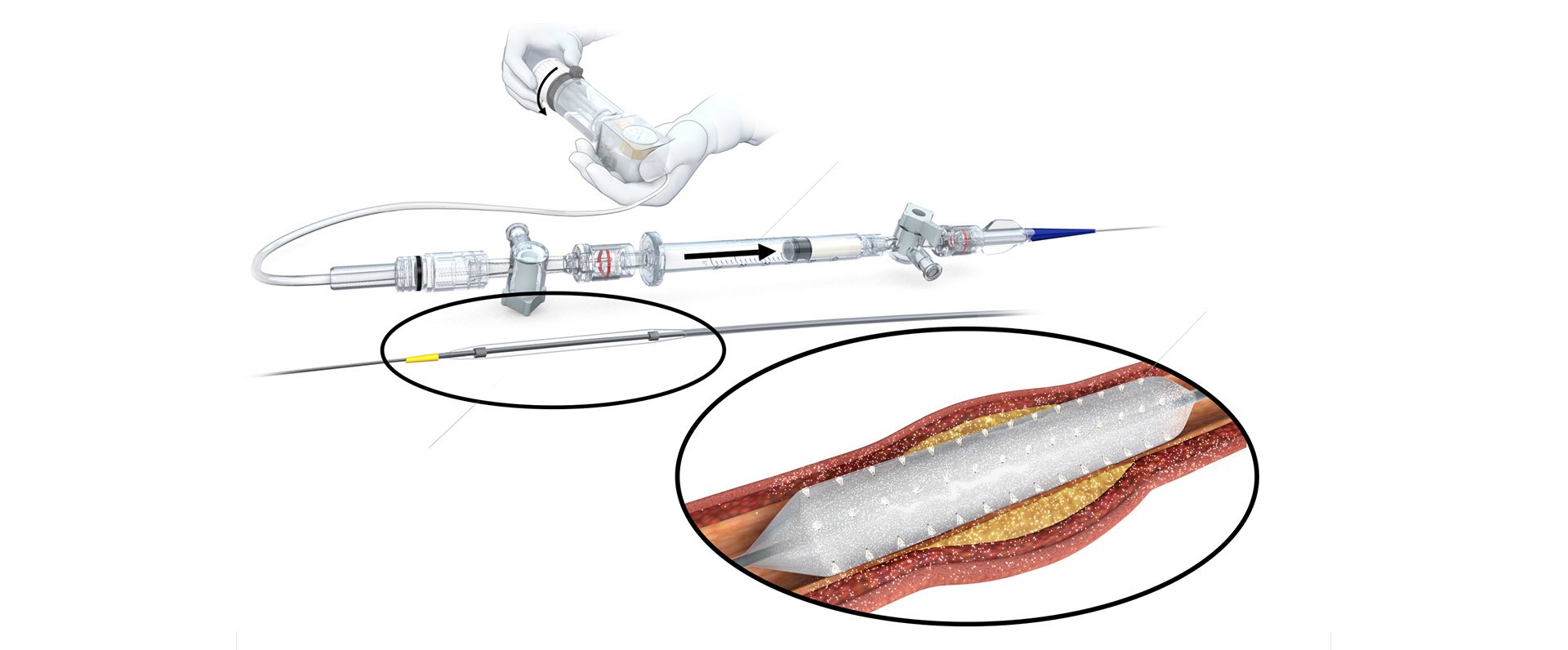 Novel AngioInfusion Balloon